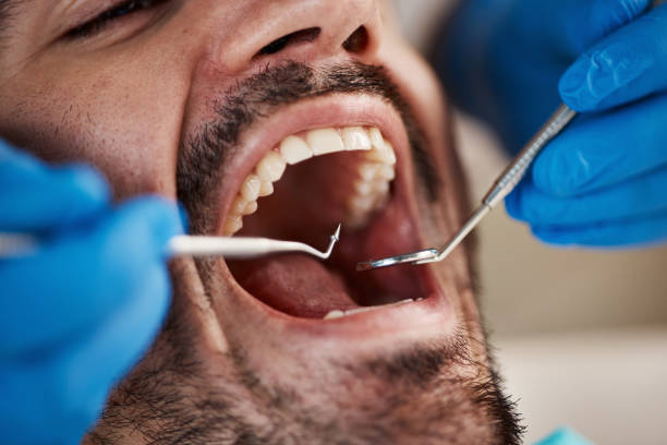 Best Emergency Dentist for Lost Fillings or Crowns in Wenona, IL