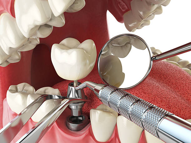 Best Broken or Cracked Tooth Emergency Dentist in Wenona, IL
